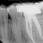 Ενδοδοντία Εικόνα 01