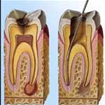 Ενδοδοντία Εικόνα 02