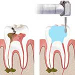 Ενδοδοντία Εικόνα 03