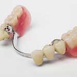 Κινητή Προσθετική - Μερική Οδοντοστοιχία