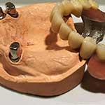 Κινητή Προσθετική - Μοντέλο Οδοντοστοιχίας σε εκμαγείο