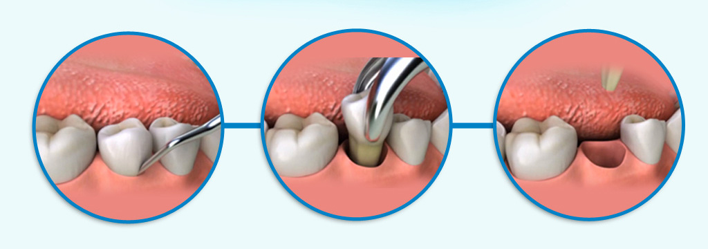 Χειρουργική Στόματος - Στάδια